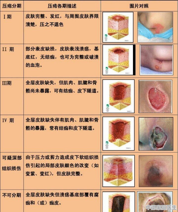 最新壓瘡分期與管理方法概述